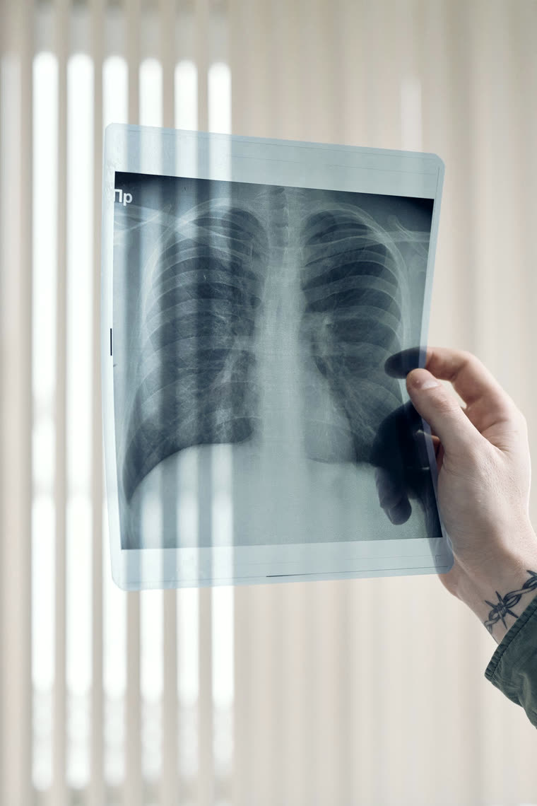 Radiografia del torace osservata in controluce
